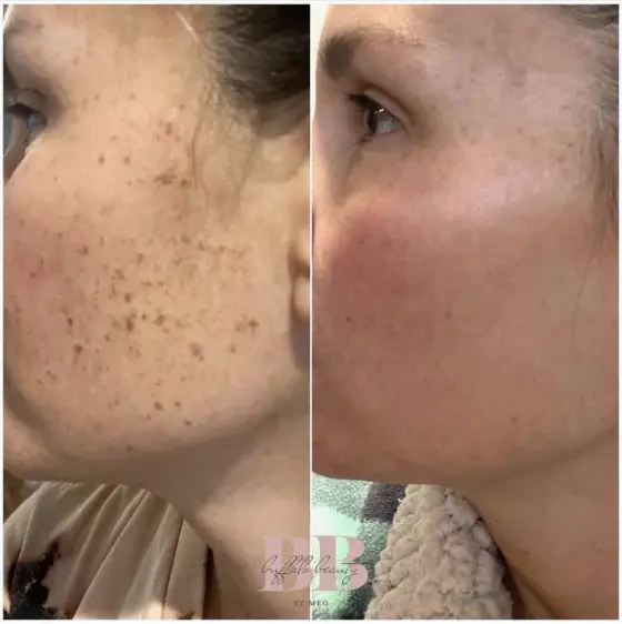 Glacial Gloss Facials before and after, client 2