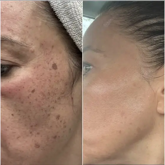 Skin treatment before and after, photo 10