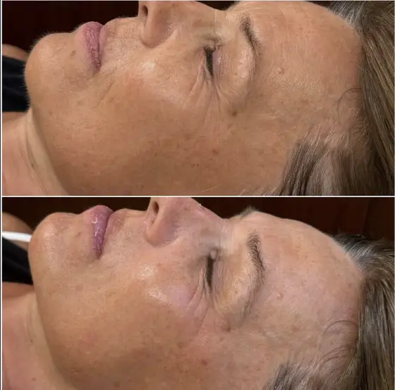Glacial Gloss Facials before and after, client 3