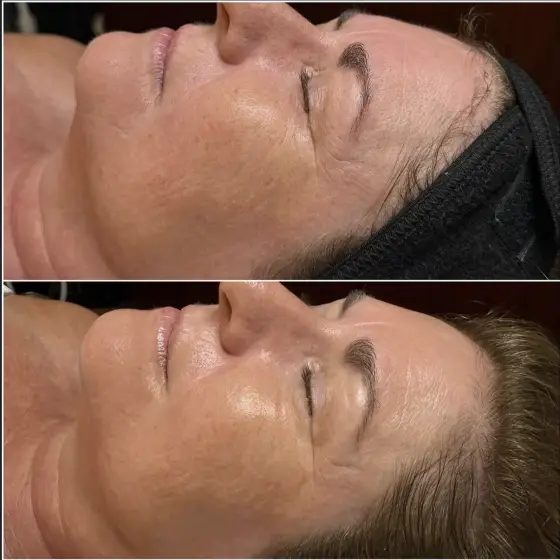Glacial Gloss Facials before and after, client 1