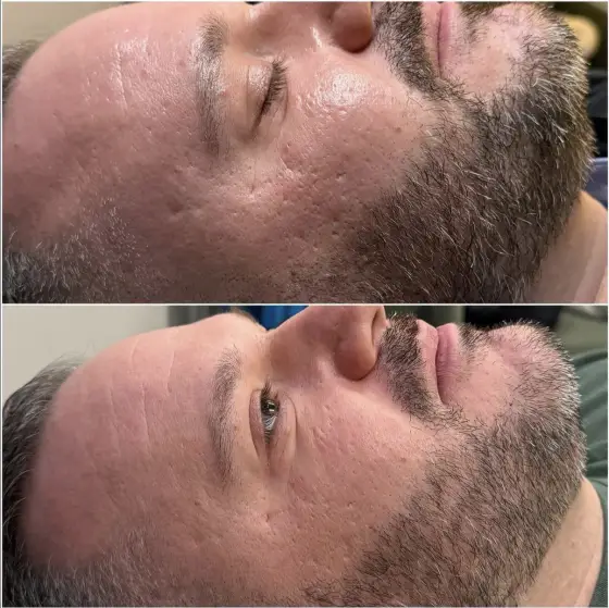 Glacial Gloss Facials before and after, client 4