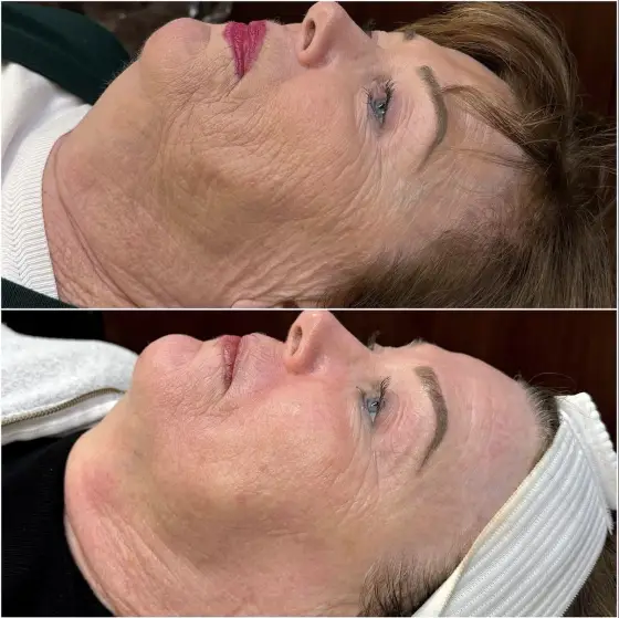 Skin treatment before and after, photo 15