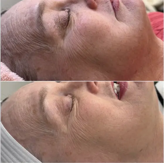 Skin treatment before and after, photo 16