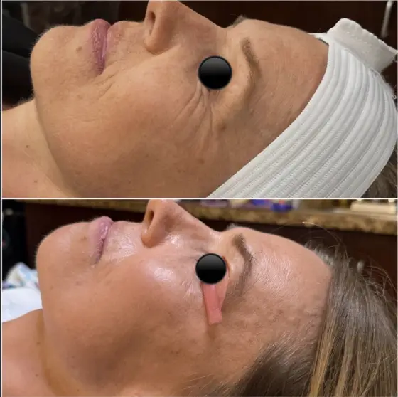 Skin treatment before and after, photo 17