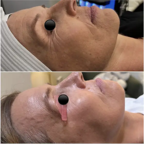 Skin treatment before and after, photo 18