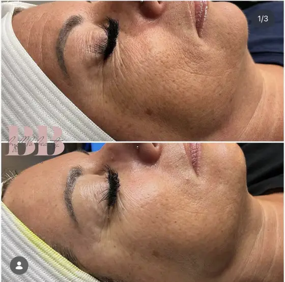 Skin treatment before and after, photo 1