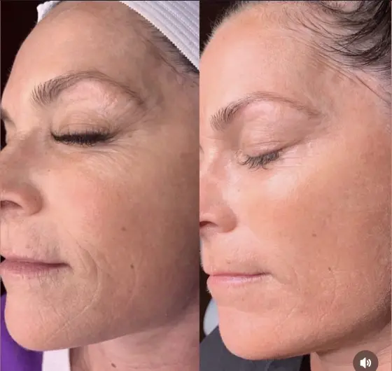 Skin treatment before and after, photo 2