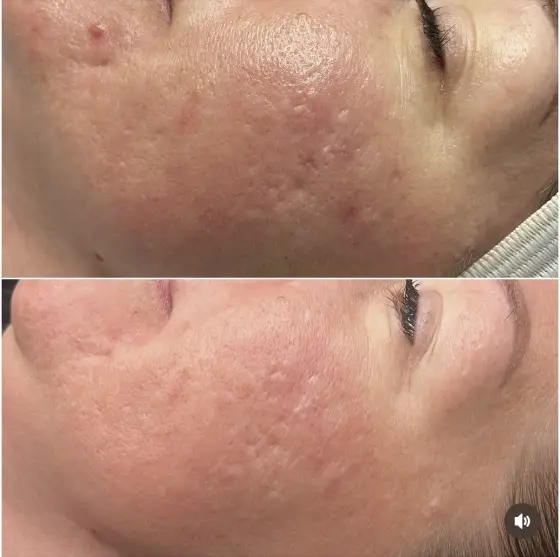 Skin treatment before and after, photo 3