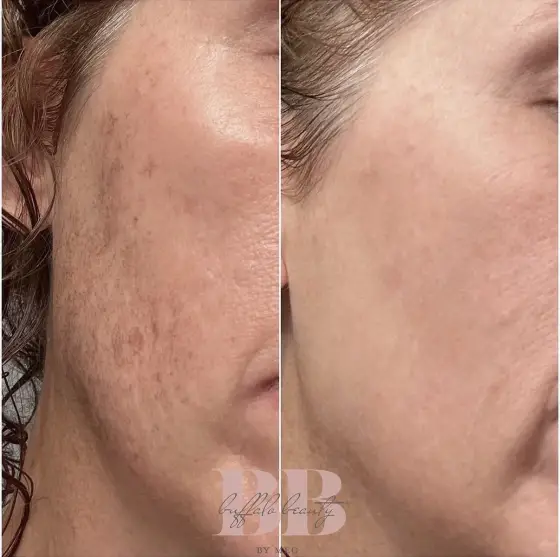Skin treatment before and after, photo 4