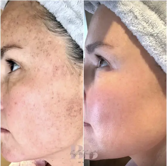 Skin treatment before and after, photo 5