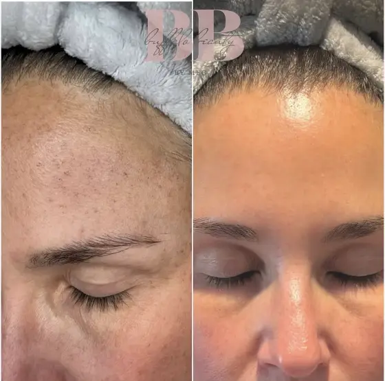 Skin treatment before and after, photo 6