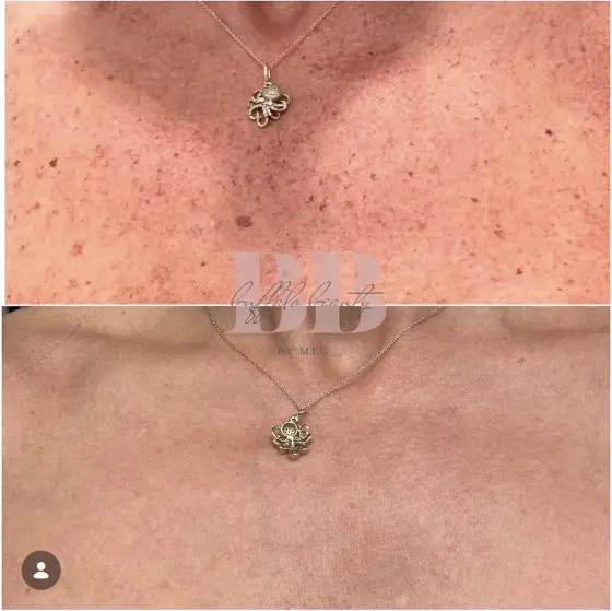 Skin treatment before and after, photo 7