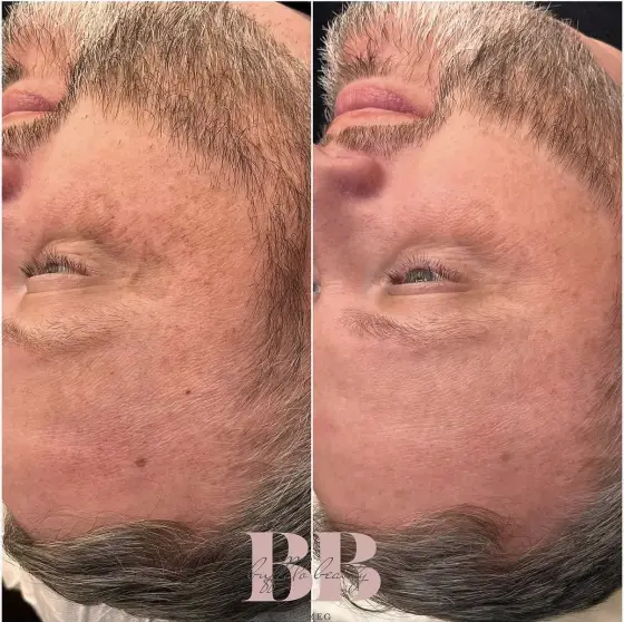 Skin treatment before and after, photo 8