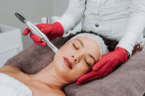 microneedling buffalo ny